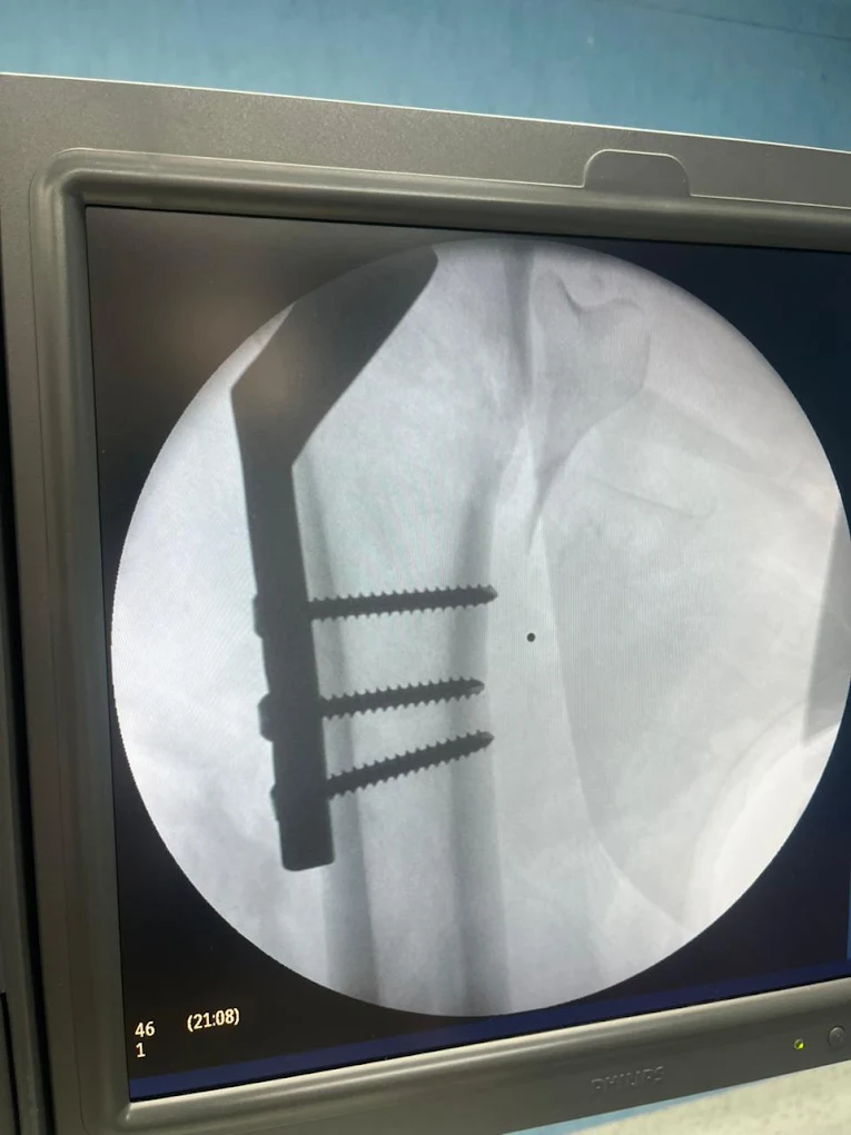 Radiografía de una fractura tratada
