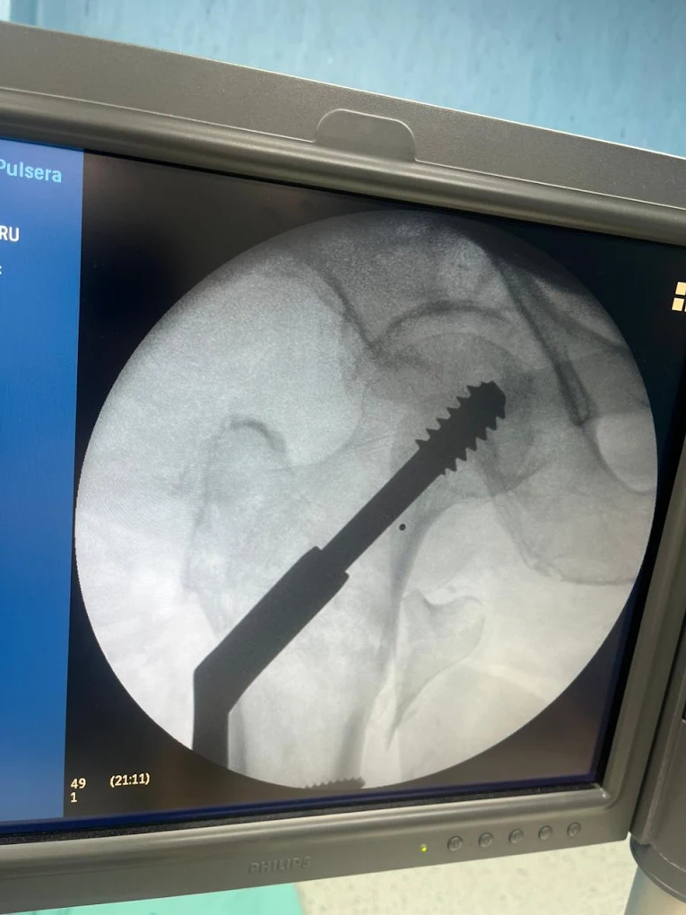 Imagen radiológica de tratamiento de cadera
