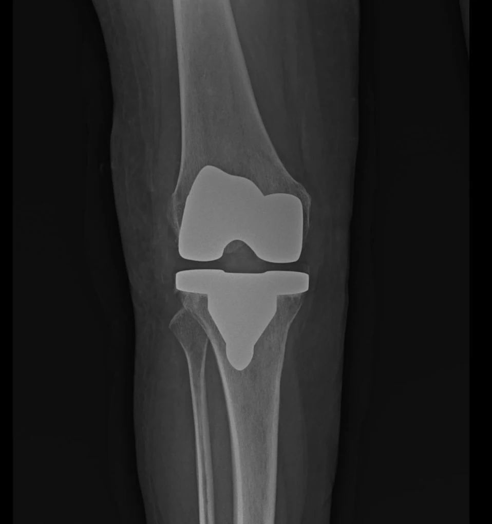 Radiografía de prótesis de rodilla